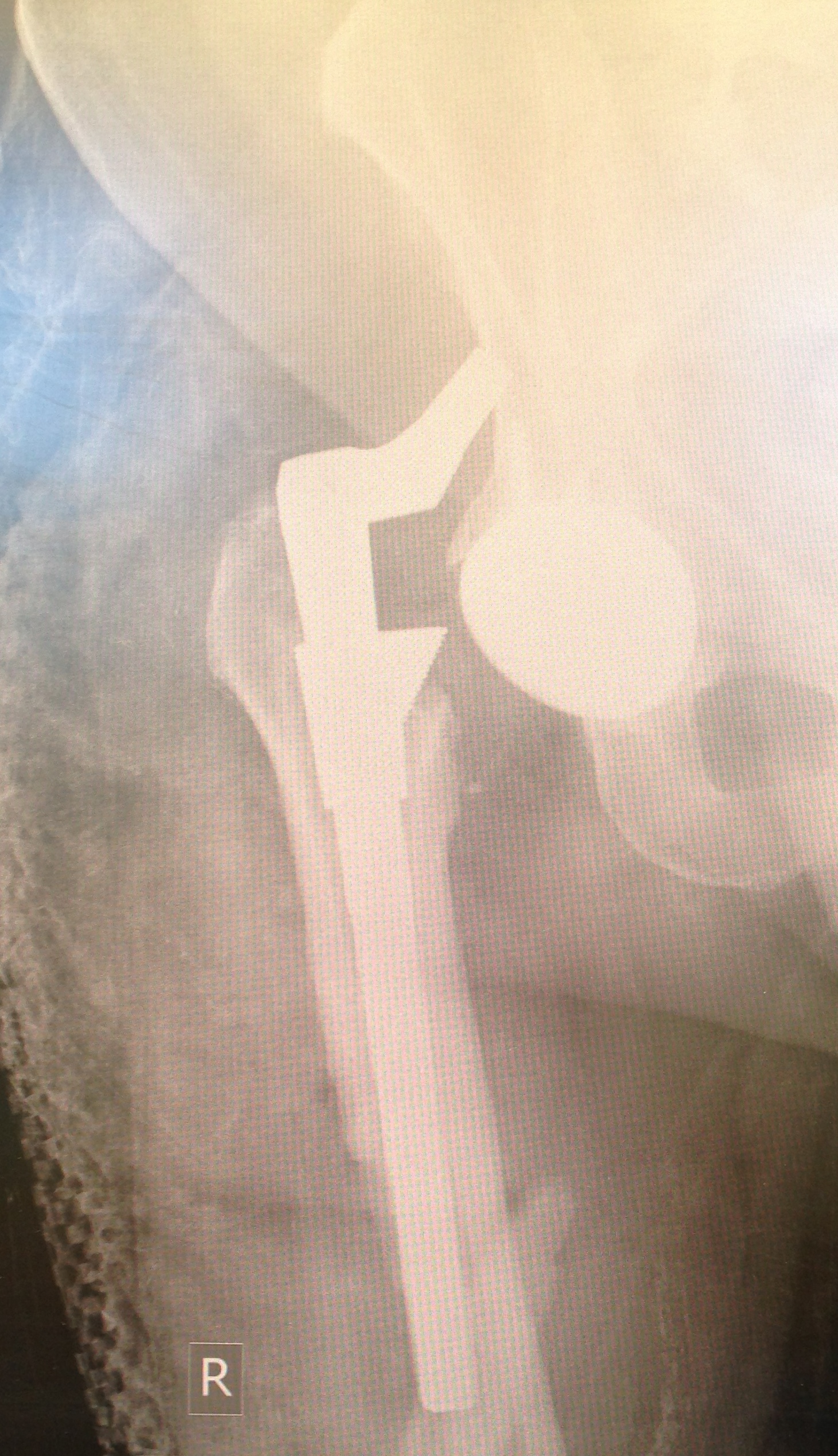 Hip Prostheses:  Total, Revision:  S-ROM (Implant 1407074)